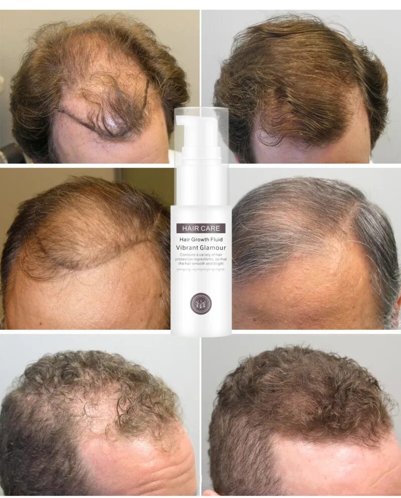 Выпадение волос после маски. Anti-hair loss hair growth Fluid. Масло от облысения для мужчин. Волос от выпадения волос. Средство для облысения волос.