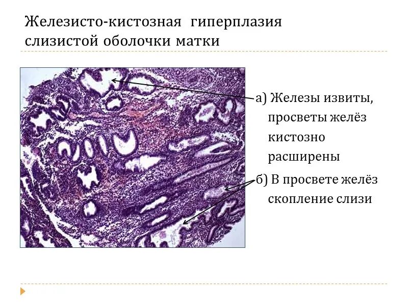 Железы слизистой оболочки матки микропрепарат. Гиперплазия эндометрия микропрепарат. Железисто-кистозная гиперплазия эндометрия микропрепарат. Железисто-кистозная гиперплазия гистология. Железы кистозно расширены