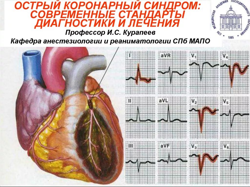 Острый коронарный синдром инфаркт. Диагностика инфаркта миокарда и коронарного синдрома. ЭКГ диагностика острого коронарного синдрома. Острый инфаркт миокарда трансмуральный диагностика. Острый коронарный синдром и острый инфаркт миокарда.