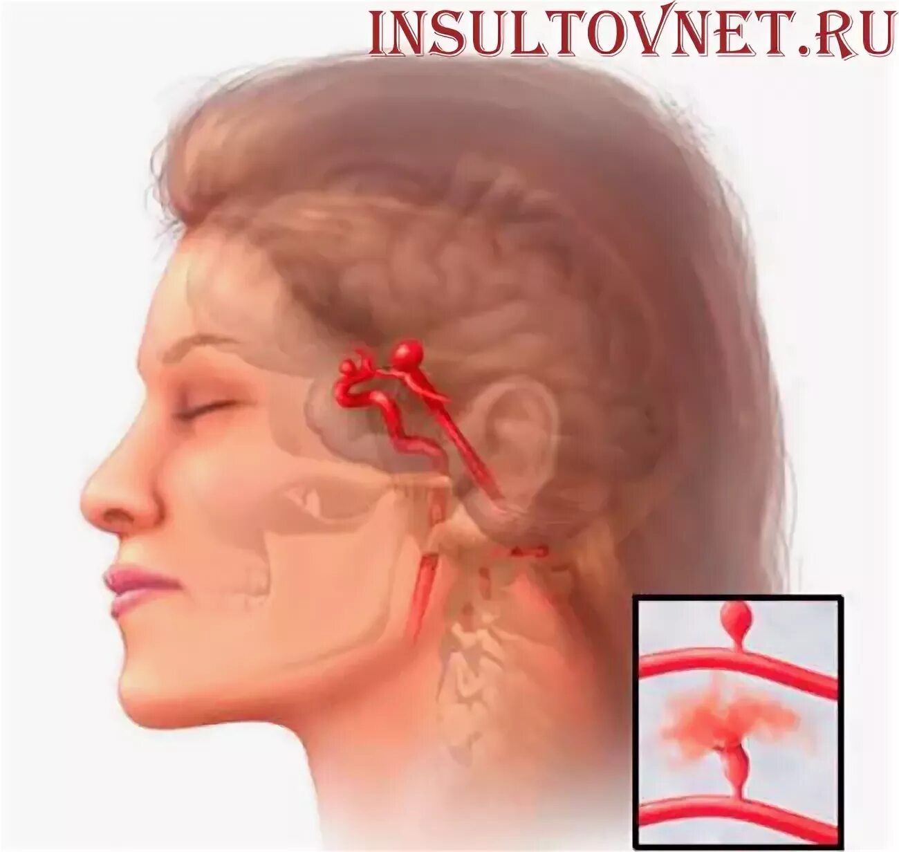 Шишки после инсульта. Аневризма головного мозга. Аневризму головного мозга в голове. Аневризма головного мозга проявления. Аневризм артерий головного мозга.