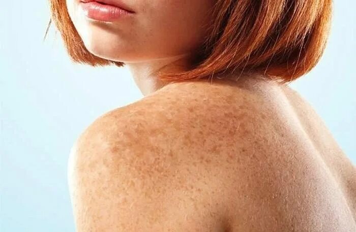 Отрубевидный лишай Девержи. Pityriasis versicolor отрубевидный лишай. Отрубевидный лишай загар. Пигментные пятна лентиго.