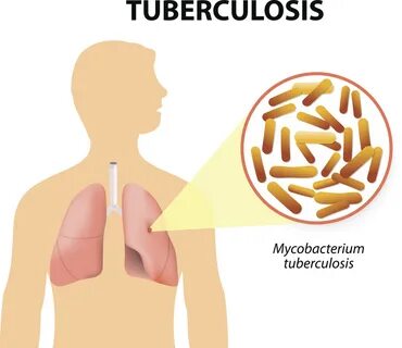 Tuberculosis