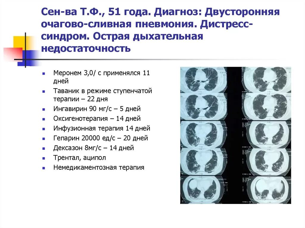 В 19 лет диагноз. Диагноз двусторонняя пневмония. Очагово сливная пневмония. Очагово сливная пневмония диагностика. Диагностика двусторонней очаговой пневмонии.