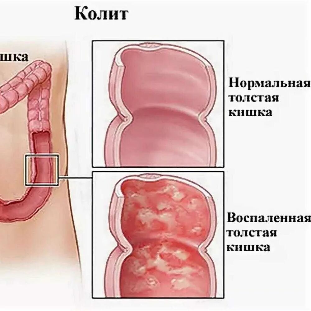 Чем грозит воспаление. Язвини колить толскишка. Что такое язвенный колит Толстого кишечника. Симптомы колит кишечника симптомы. Неспецифический язвенный колит (няк).