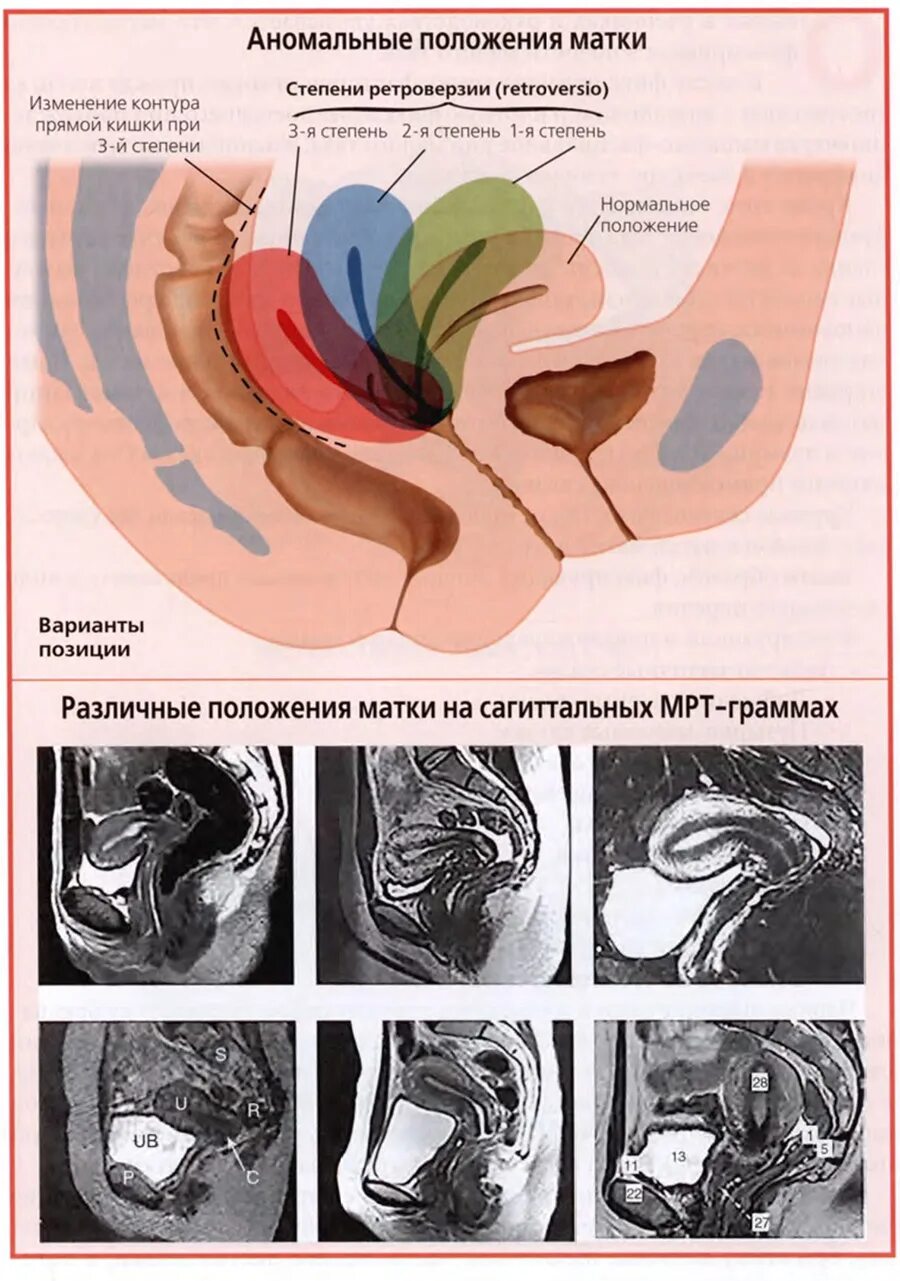 Расположение матки anteflexio. Антефлексио и ретрофлексио матка. Антеверзио антефлексио. Загиб матки антефлексио.