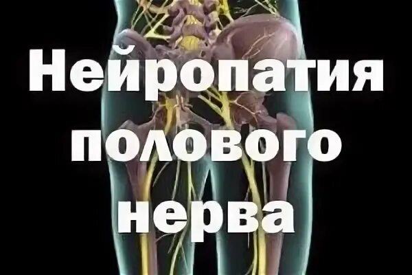 Половой нерв у мужчин симптомы. Нейропатия полового нерва. Невралгия полового нерва. Упражнения для полового нерва. Ущемление полового нерва.