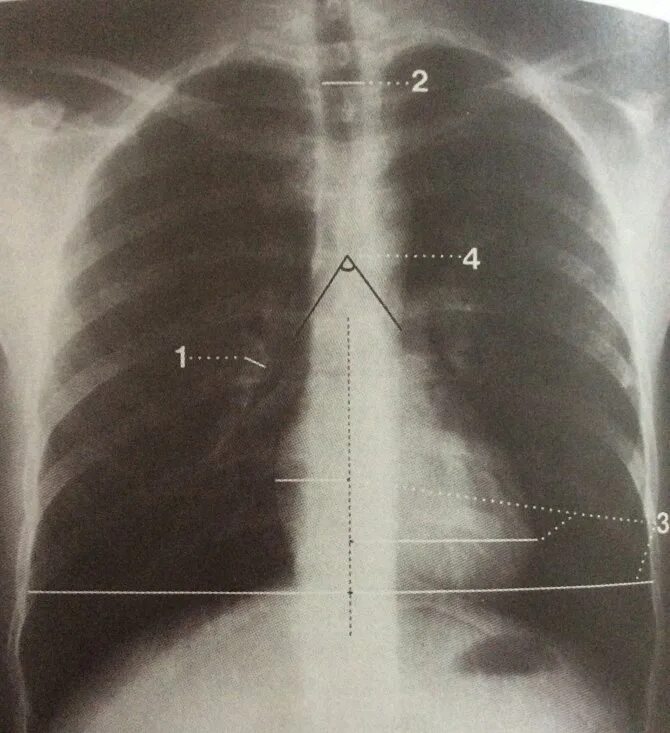 Верхние доли легких тени. Патология диафрагмы на рентгенограмме. Рентген грудной клетки и флюорография. Реберно диафрагмальный угол на рентгене. Реберно диафрагмальный синус на рентгенограмме.