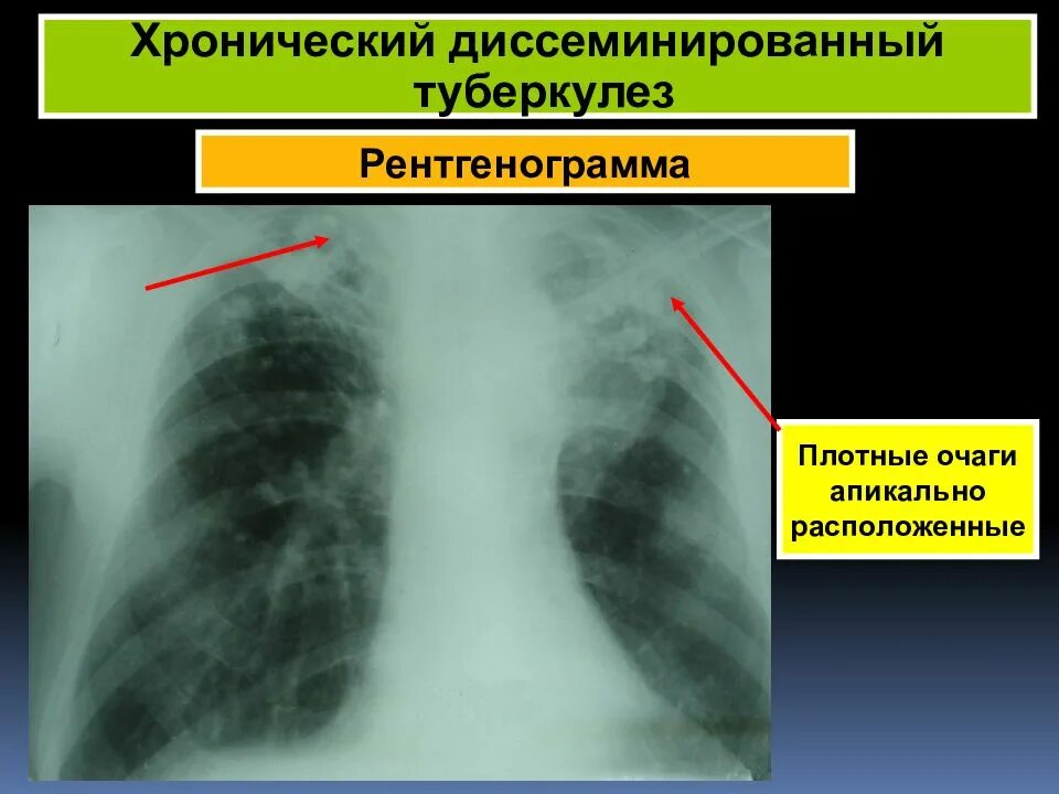 Диссеминированный туберкулез фаза инфильтрации