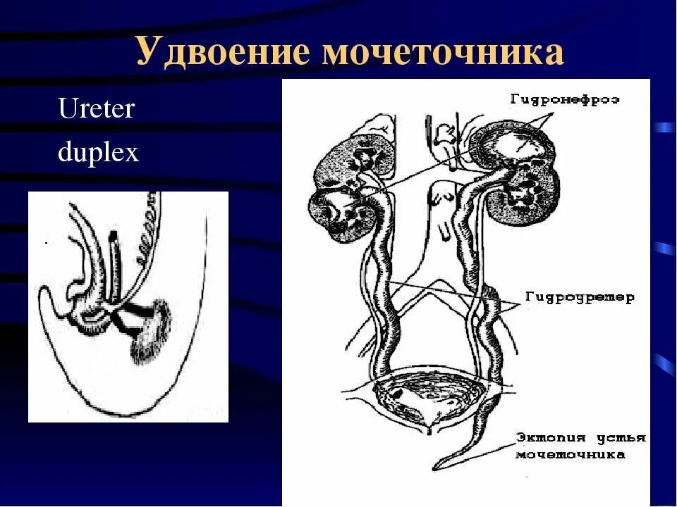 Удвоение почки удвоение мочеточника. Неполное удвоение мочеточника. Аномалии развития мочеточников. Удвоение верхних мочевых путей это. Обоих мочеточников