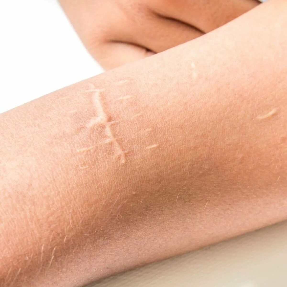 Гипертрофические и келоидные рубцы. Рубец размеры. Келлоидный гипертрофический рубец. Рубец сычуг книжка сетка у животных. Рубец размеры.