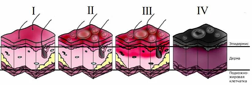 3 й стадии. Термический ожог 4 степени.
