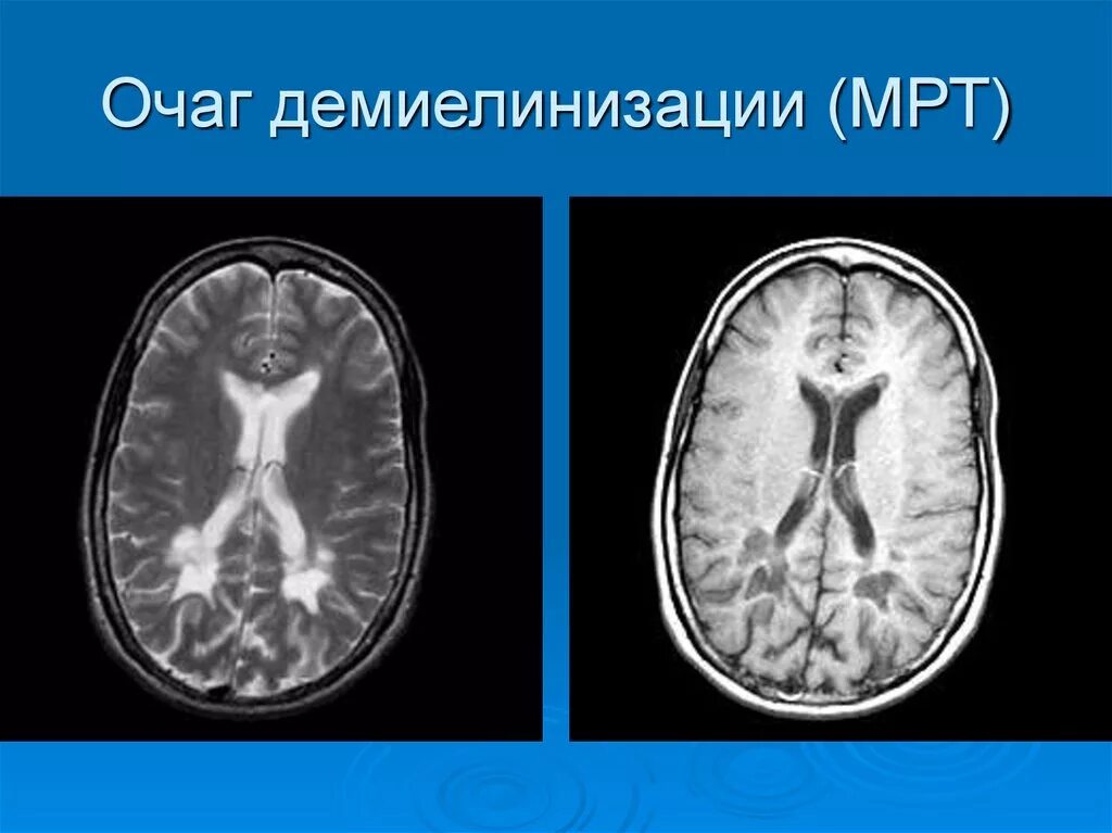 Склероз мозга. Очаги демиелинизации на мрт. Демиелинизация головного мозга мрт. Мрт рассеянный склероз очаги демиелинизации. Демиелинизирующие заболевания головного мозга мрт.