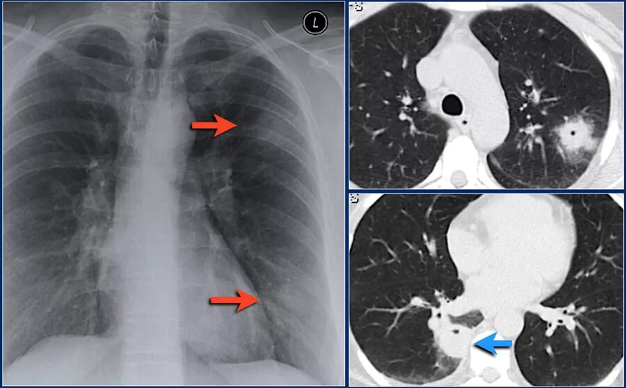 клетки воспалительного инфильтрата.