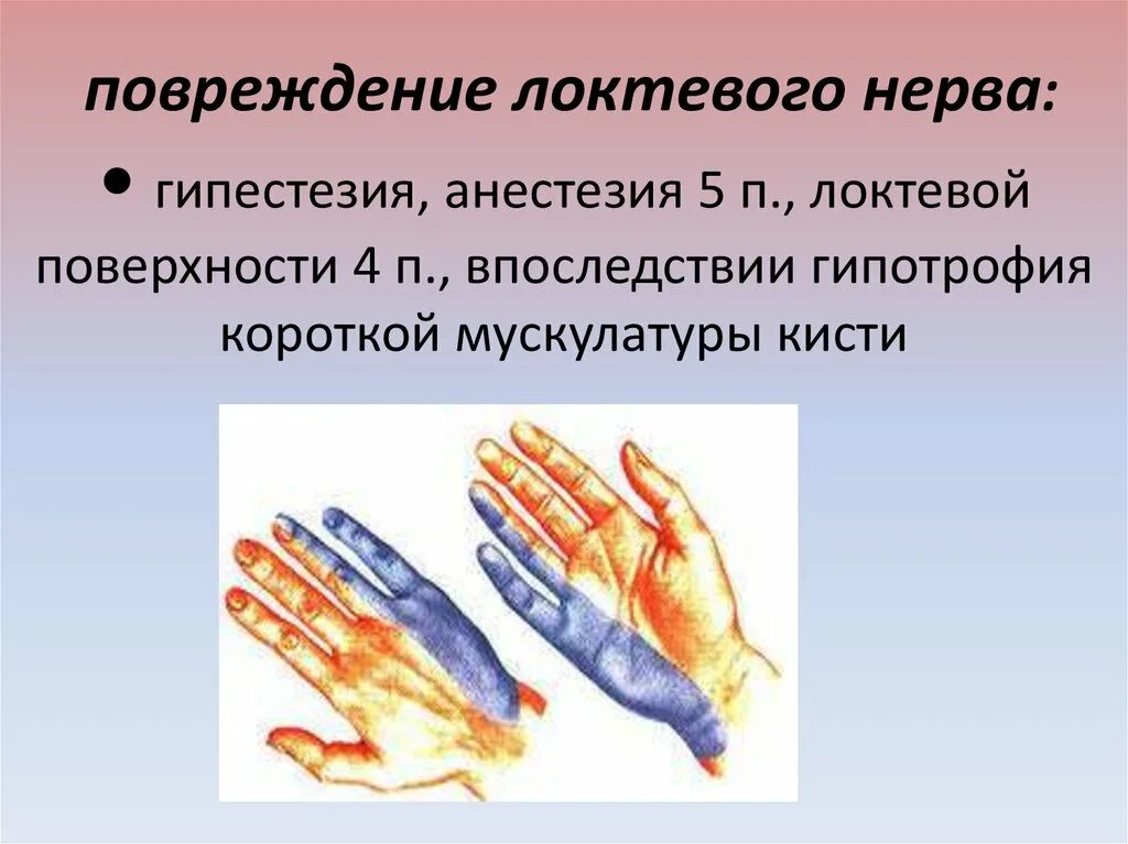 Нейропатия локтевого нерва клиника. При поражении локтевого нерва. Поражение локтевого нерва симптомы.