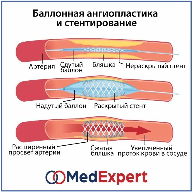 Баллонная коронарная ангиопластика. Баллонная ангиопластика сосудов сердца. ТРАНСЛЮМИНАЛЬНАЯ ангиопластика. Баллонная ангиопластика нижних конечностей. Баллонная ангиопластика и стентирование.