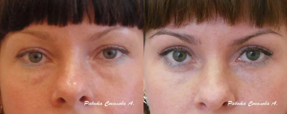 Блефаропластика мелоян мхитар. Круглые глаза после блефаропластики. Трансконъюктивальная пластика век. Нижняя блефаропластика трансконъюктивальная. Выворот верхнего века блефаропластика.