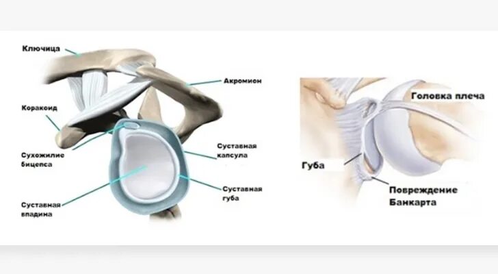 Повреждение губы плечевого сустава. Перелом Хилл-Сакса плечевой кости. Повреждение Банкарта операция и Хилл-Сакса плечевого сустава. Суставная губа плечевого сустава анатомия. Хрящевая губа плечевого сустава.