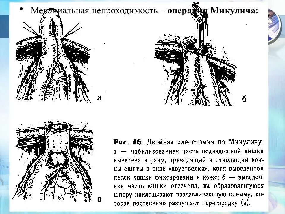 Резекция сигмовидной кишки по микуличу. Операция микулича на толстой кишке. Резекция по микуличу. Резекция сигмовидной кишки по микуличу. Пилоропластика гейнеке-микуличу.