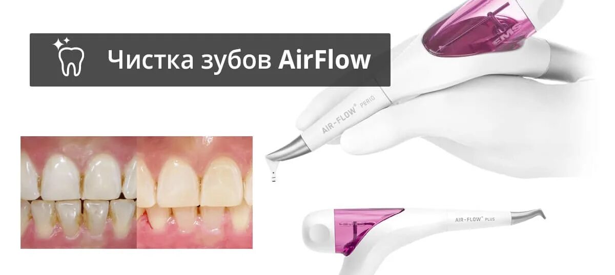 Air Flow АИР флоу. Отбеливание эмали зубов методом «Air-Flow». Отбеливание Air-Flow до и после.