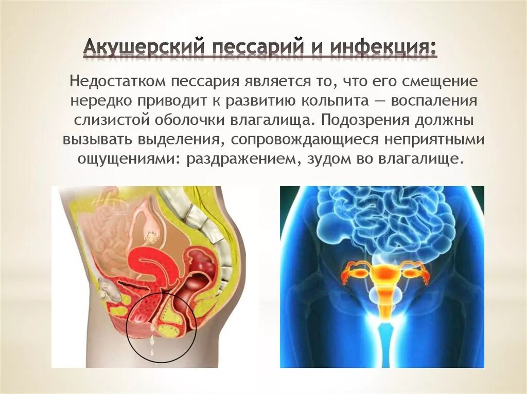 ИЦН акушерский пессарий. Пессарий инфицирование. Можно с пессарием заниматься