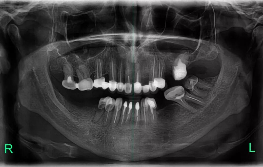 Снимок зубов видное. Ортопантомография (ОПТГ). Ортопантомограмма (ОПГ). Панорамный снимок челюсти ОПТГ. Панорамный рентген челюсти ОПТГ.