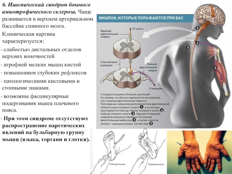 Боковой амиотрофический склероз причины заболевания. Боковой амиотрофический склероз пояснично-крестцовая форма. Синдром бокового амиотрофического склероза. Амиотрофический латеральный склероз. Боковой латеральный амиотрофический склероз.