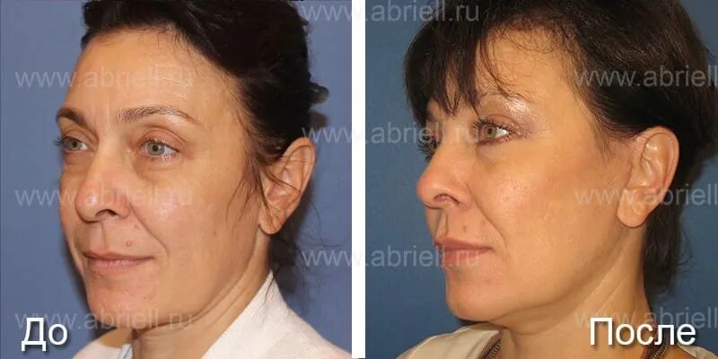 Липофилинг груди в Москве: цены, фото до и после, отзывы Хирург Анна Тваури