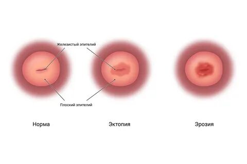 Чем отличается эрозия 
