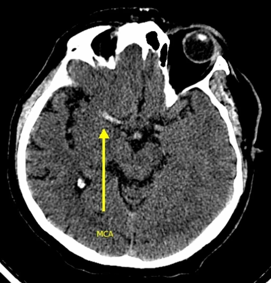 Тромбоз артерии мозга. Тромбоз артерий головного мозга на кт. Тромбоз сосудов головного мозга на кт. Тромбоз СМА на кт. Тромбоз средней мозговой артерии.