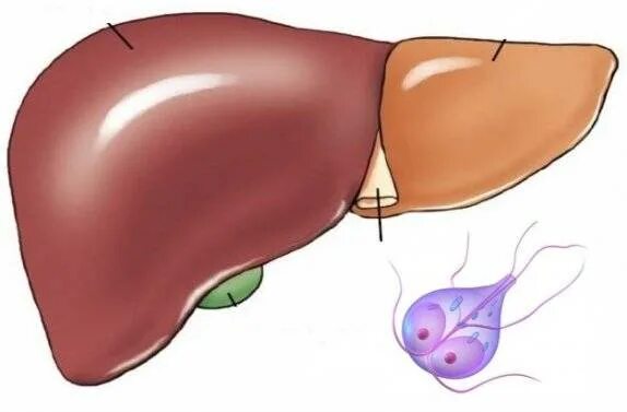 Симптомы печени у ребенка. Лямблиоз в желчном пузыре. Лямблиоз гепатобилиарная форма. Паразиты в печени лямблии.