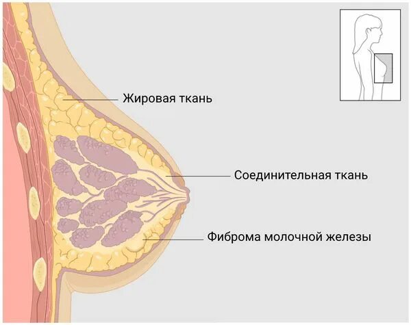 Фиброма в груди. Фиброма молочной железы. Строма молочной железы. Фибридема груди. Фиброма в молочной железе.