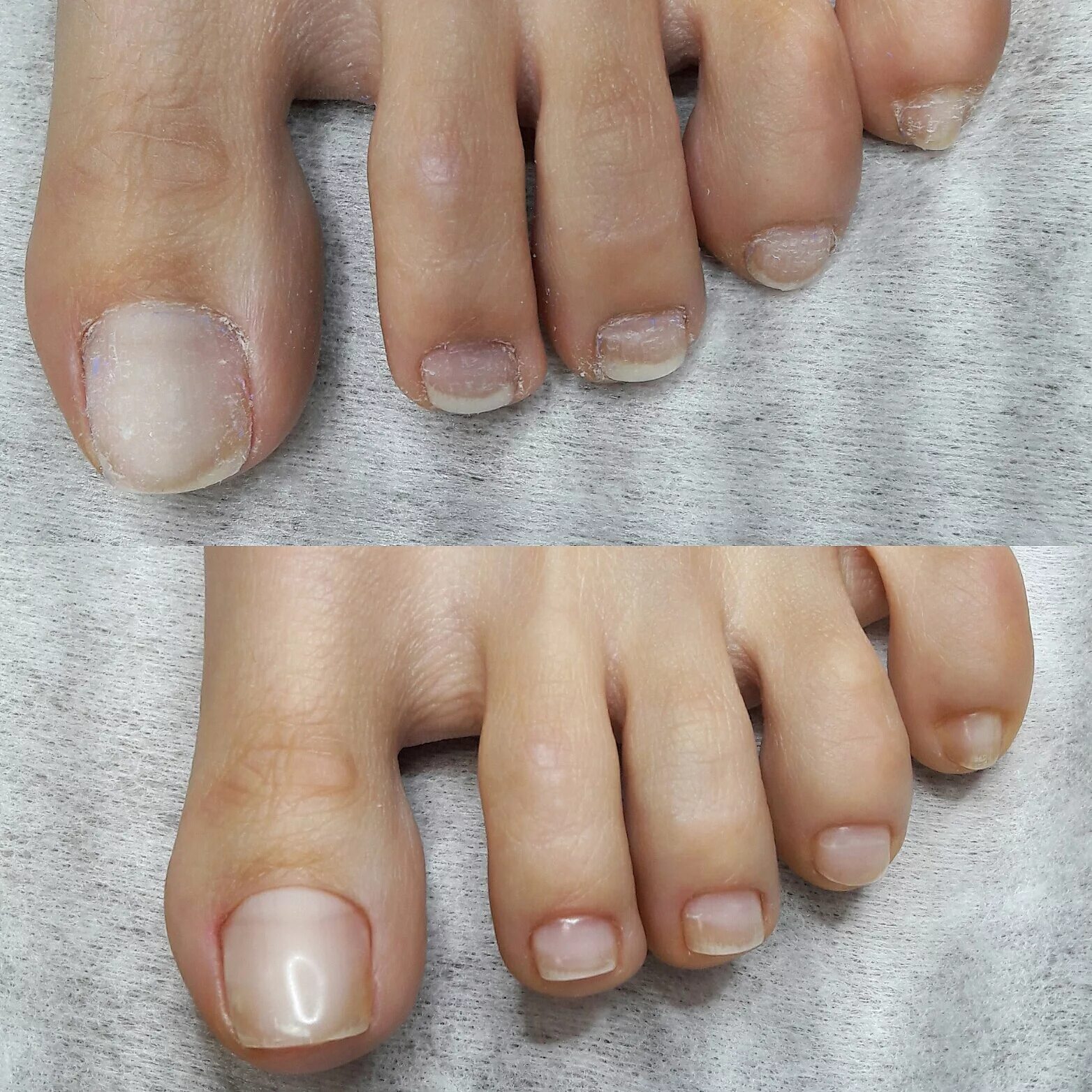 Педикюр до и после. Педикюр без покрытия. Биоламинирование ногтей. Биоламинирование ногтевой пластины. Лечебное ламинирование ногтей.
