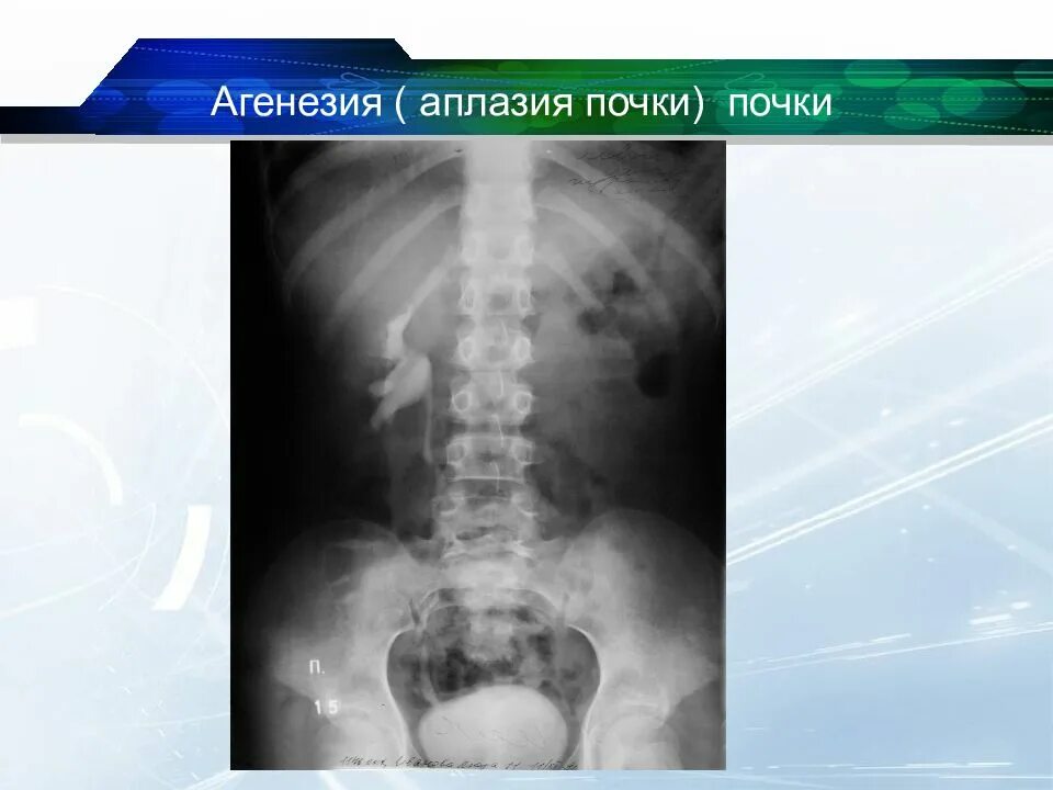 Врожденная гипоплазия почки. Агенезия и аплазия почки. Аномалии развития легких. Врожденные аномалии почек агенезия. Аплазия мочеточника рентген.