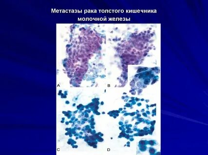 Метастазы в костях при раке молочной железы
