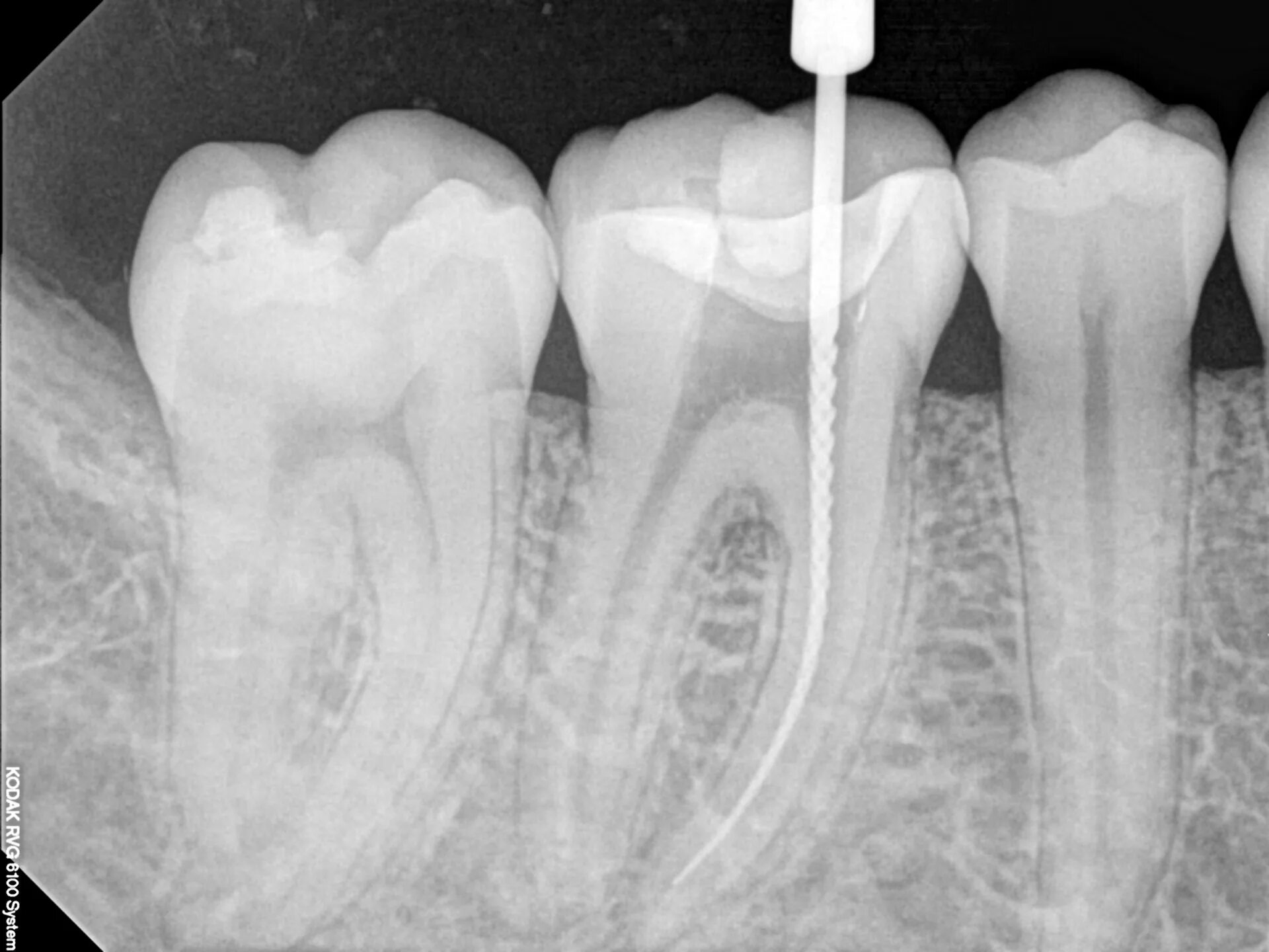 Root canal. 4 Канальный пульпит зуба. Запломбированные корневые каналы.