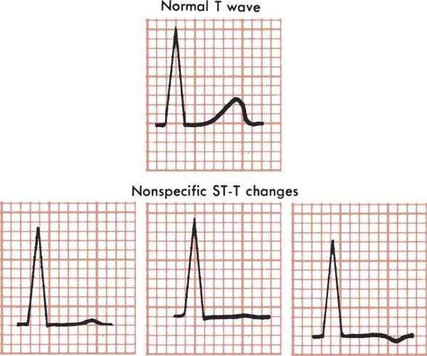 Умеренные неспецифические изменения. Изменения сегмента St на ЭКГ. Изменение сегмента St и зубца t на ЭКГ что это такое. Неспецифические изменения сегмента St на ЭКГ. Изменения зубца t на ЭКГ.