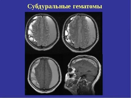 Субдуральные гематомы характерны для