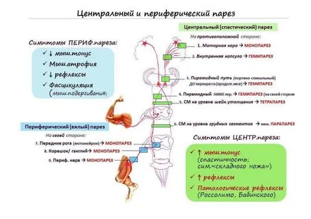 Центральный гемипарез