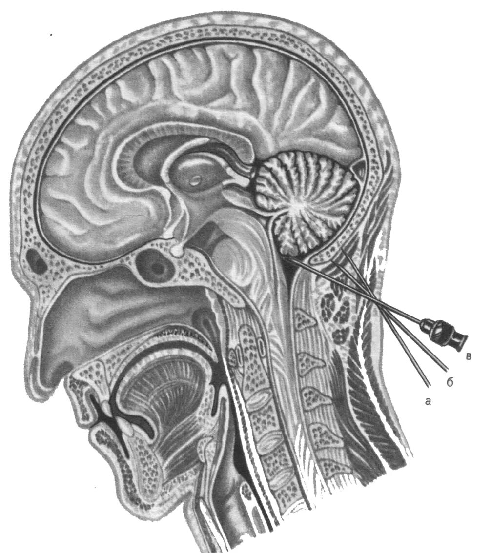 Как делают пункцию мозга. Субокципитальный пункция. Субокципитальная Трепанация. Субокципитальная пункция черепа. Пункция мозжечково-мозговой цистерны.