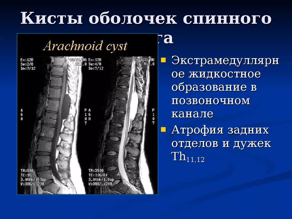 Киста в грудном отделе позвоночника. Эпидуральная киста позвоночного канала. киста конуса спинного мозга мрт. кистозные образования спинного мозга. образования позвоночного канала мрт.