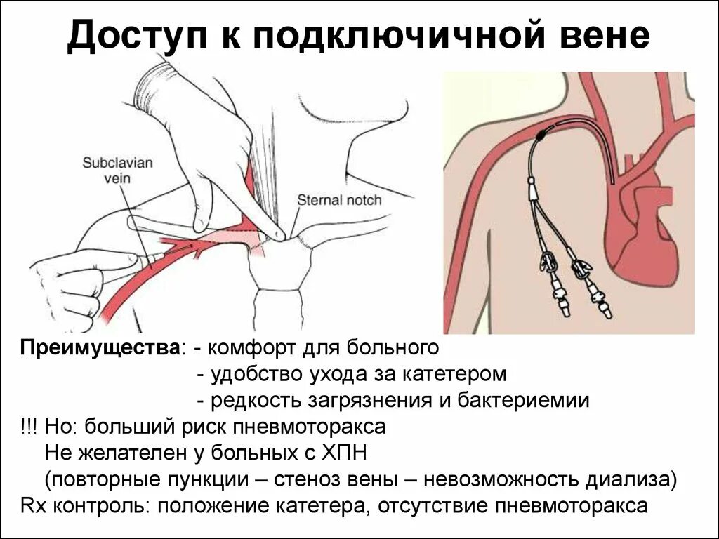 Катетеризация вен алгоритм. Постановка катетера в подключичную Вену. Пункция подключичной вены по Сельдингеру. Пункция подключичной артерии. Катетер подключчный 1.1.