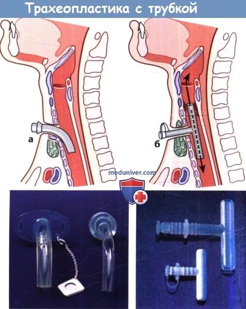 Степени острого стеноза гортани. Острый стеноз гортани дифференциальная диагностика. Стеноз дыхательных путей. Стеноз внегрудных дыхательных путей у взрослых что это. Стеноз внегрудных отделов дыхательных путей что это.