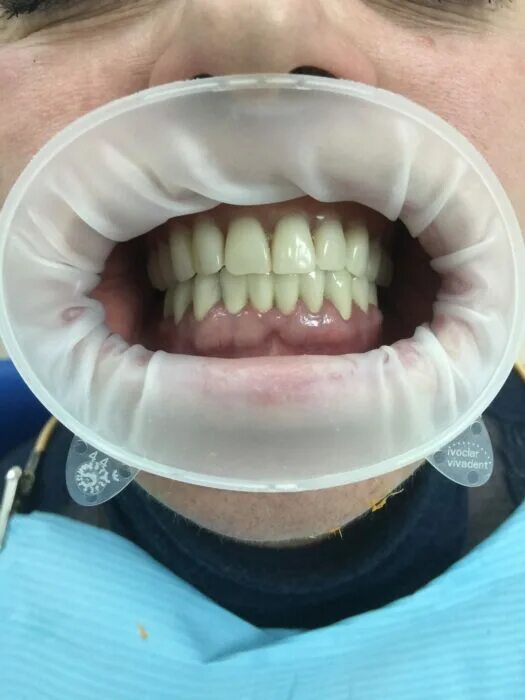 IPS e.max ® Crowns, Bridges and Inlays - Semdent