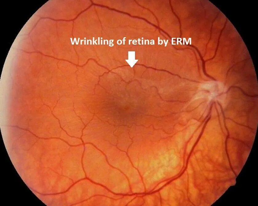 Эпиретинальный фиброз глаза. Макулярный фиброз сетчатки. Эпиретинальная мембрана сетчатки. Эпиретинальный макулярный фиброз. Отслойка сетчатки глазное дно.