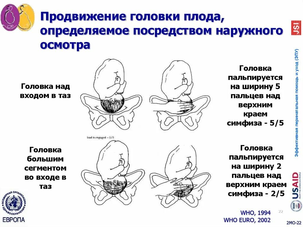 Положения головки плода. Продвижение головки плода по плоскостям. Малый сегмент головки плода. Головка большим сегментом во входе в малый таз. Головка плода на тазовом дне.