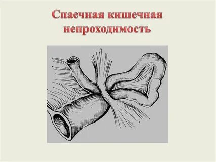 Лечение спаек