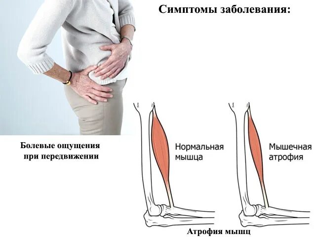 Атрофия икроножных мышц. Атрофирование мышц ног.