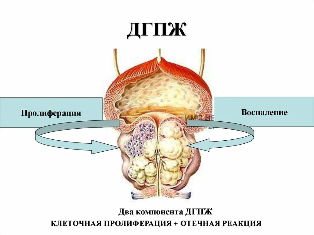 Аденома простаты возраста. Гиперплазия предстательной железы. Доброкачественная гиперплазия простаты. Гиперллазияпрестательный железы. Заболевания предстательной железы.