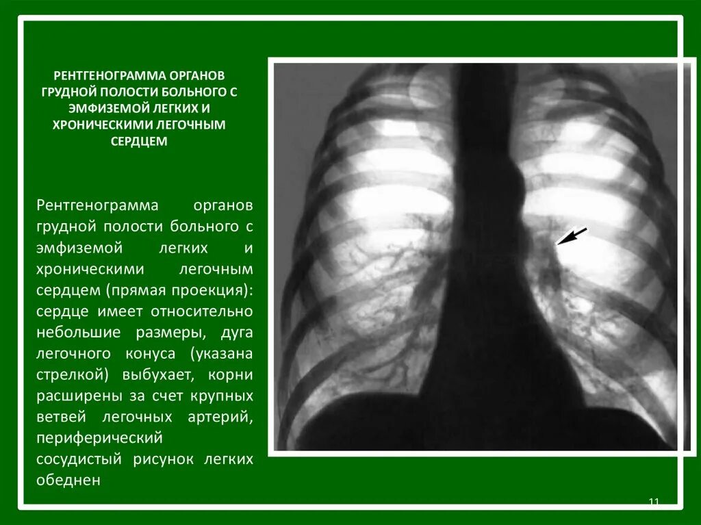 Рентген при эмфиземе легких. Рентгенологические признаки эмфиземы легких. Хроническое легочное сердце рентгенограмма. Буллезная эмфизема рентген.