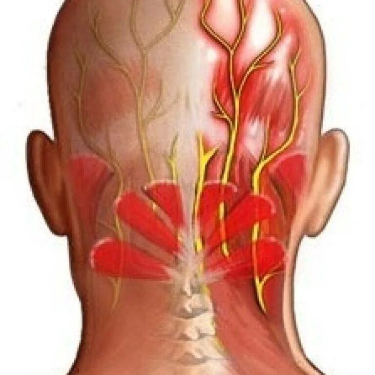 Нервы головы тройничный нерв. Facialis). Невралгия ушно-височного нерва. Схема лечения невралгии затылочного нерва медикаментами. Первичная невралгия тройничного нерва.